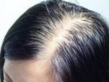 脱发治疗，必须知道头皮与头发的爱恨情仇