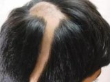 斑秃治疗|拯救斑秃患者的SKM中胚层疗法