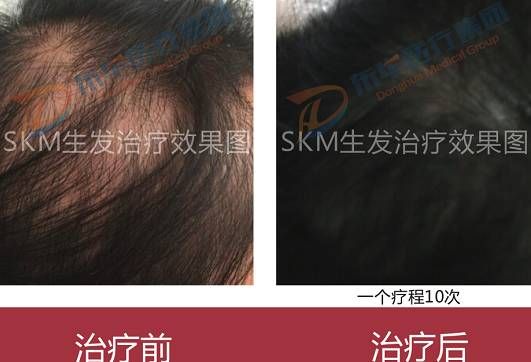 斑秃治疗案例