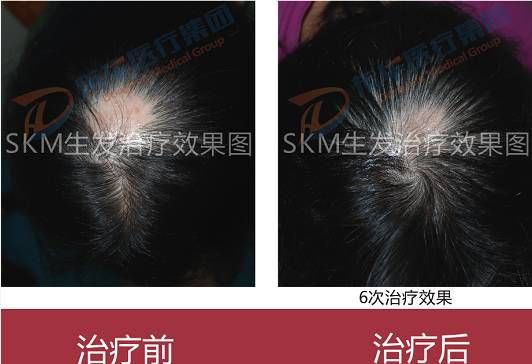 斑秃治疗案例2